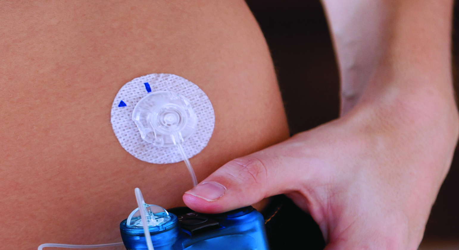 MEDICAL DEVICE FIXATION